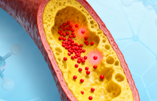 Microplastics Detected in Human Coronary Artery Plaques for the First Time